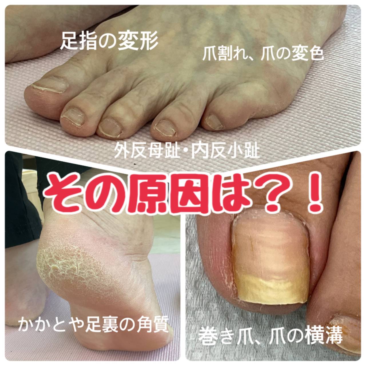 外反母趾、足裏の角質、小指の変形、爪の変色、その原因は？！