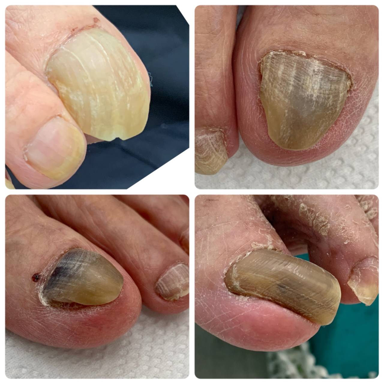 足の爪が分厚い、肥厚爪、爪甲こう湾症のケアについて