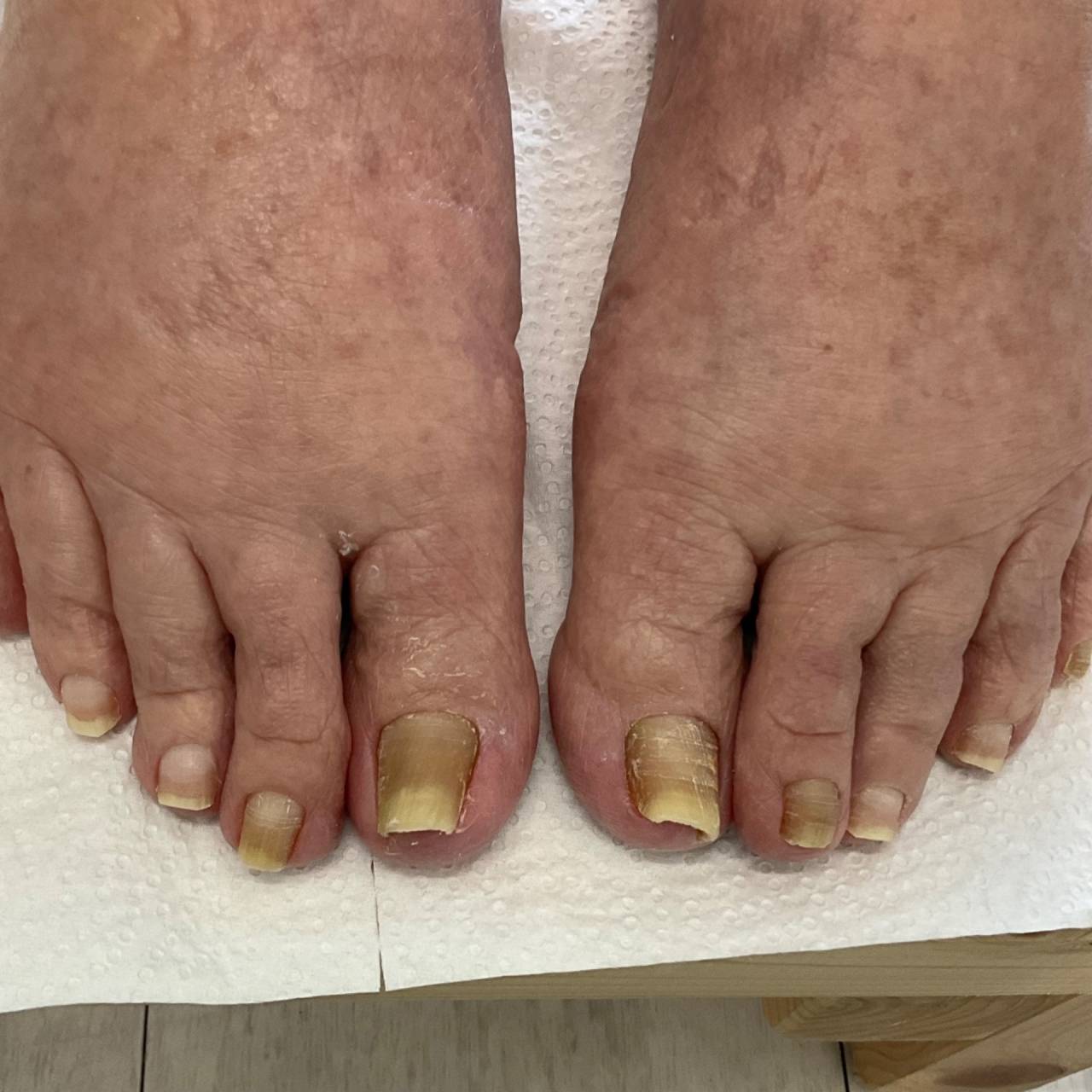 高齢者の足の爪切りは宜野湾市の爪ケア専門店へお任せください