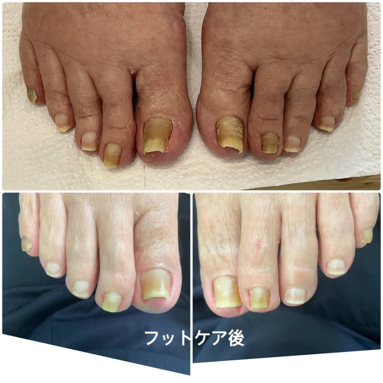 高齢者のフットケア | 爪ケア後の手指や足先をご紹介 | 宜野湾市の爪 