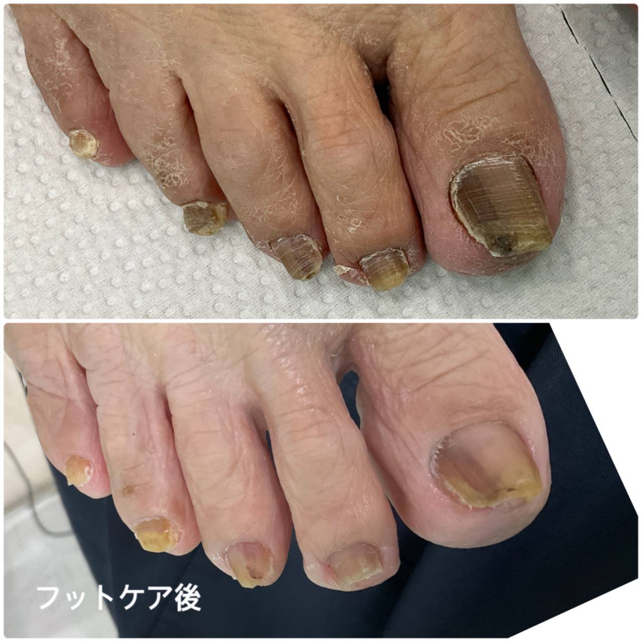 高齢者の足の爪ケア 分厚い爪、巻き爪、切りにくい爪