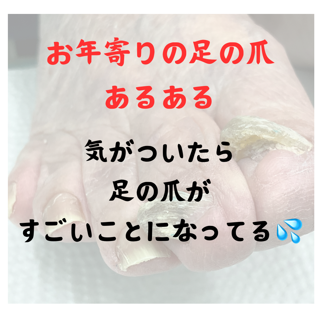 お年寄り、高齢者の足の爪切り、足の爪トラブルは爪ケア専門店へ