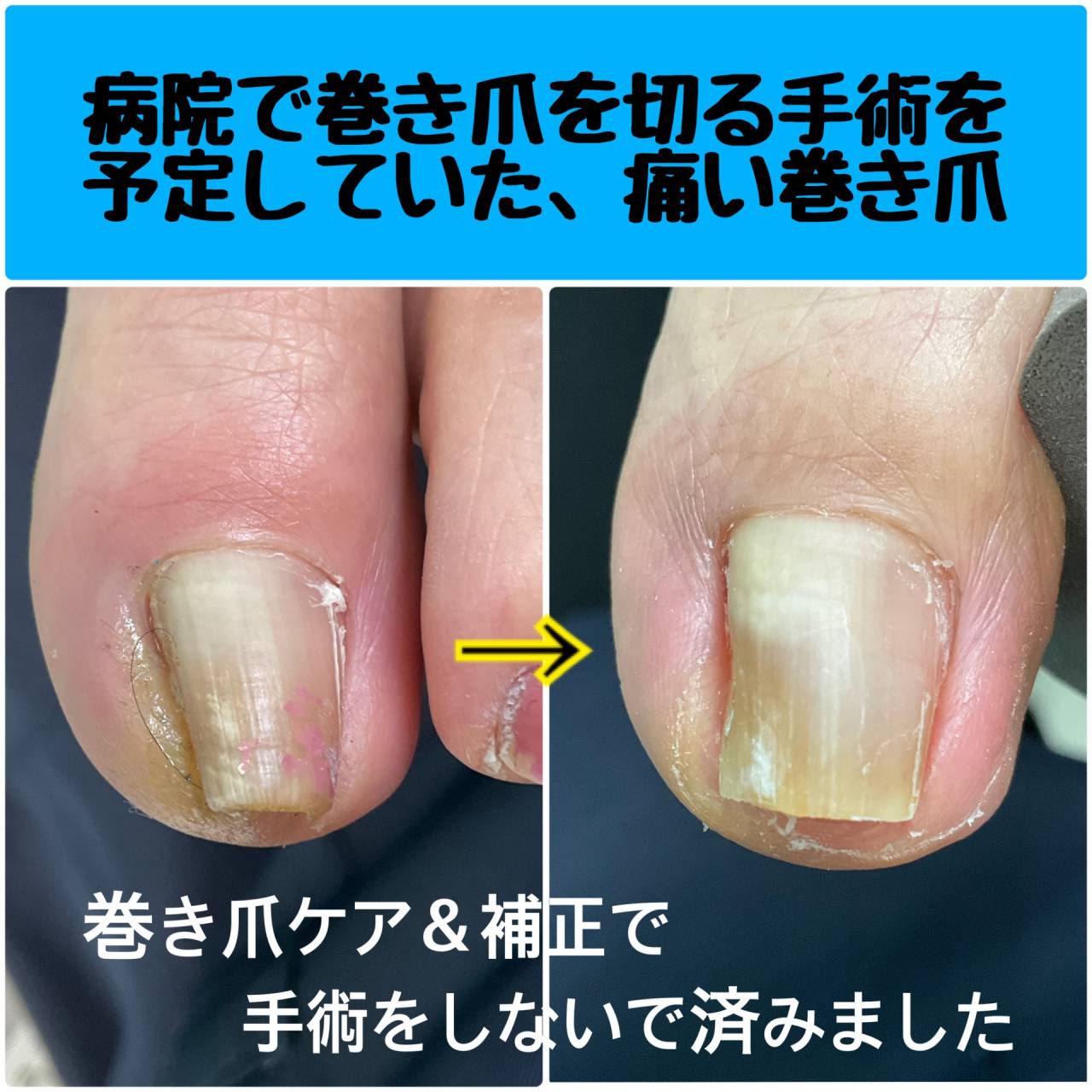 巻き爪ケアと補正で手術をせずに経過を見ています