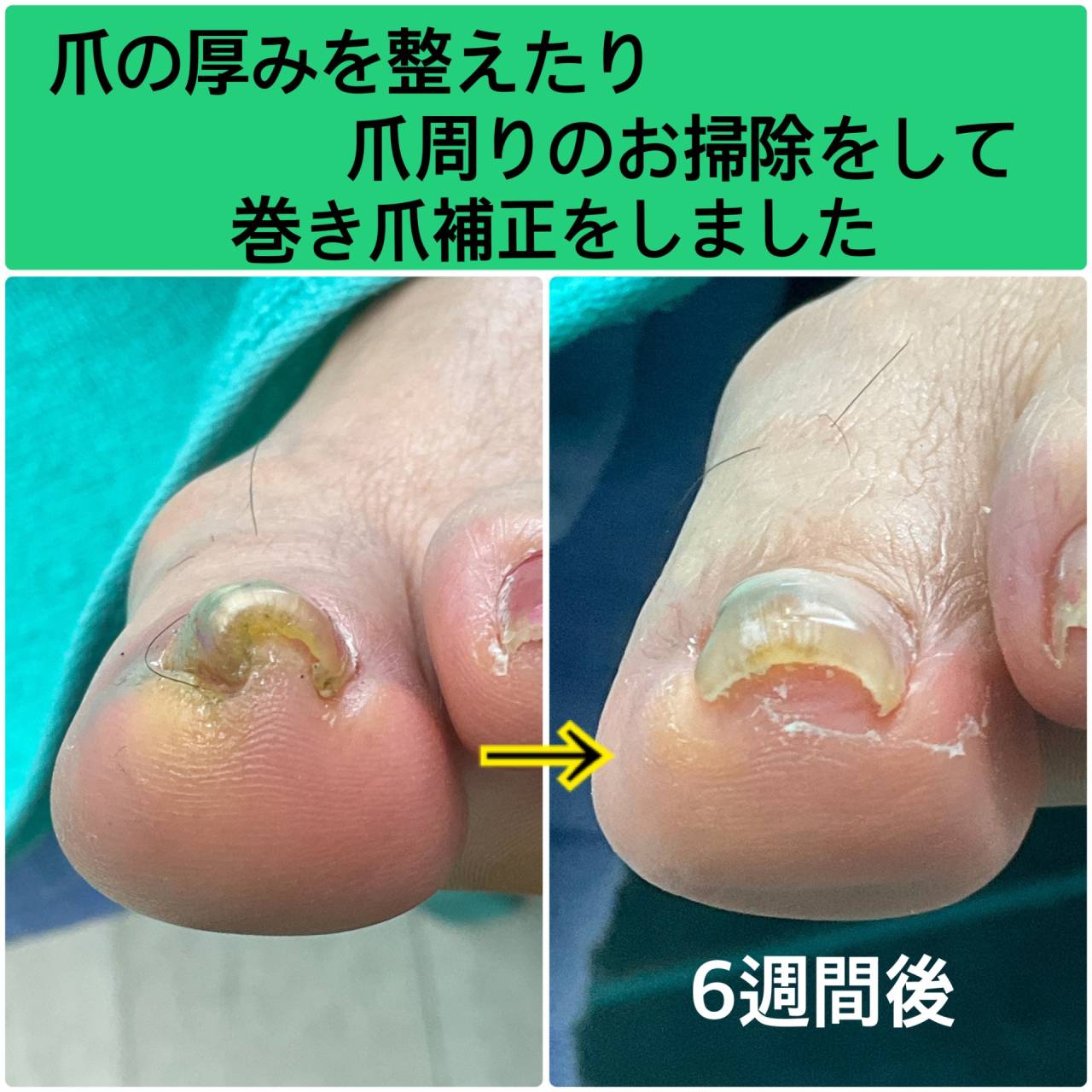 巻き爪ケアと補正で手術をせずに経過を見ています