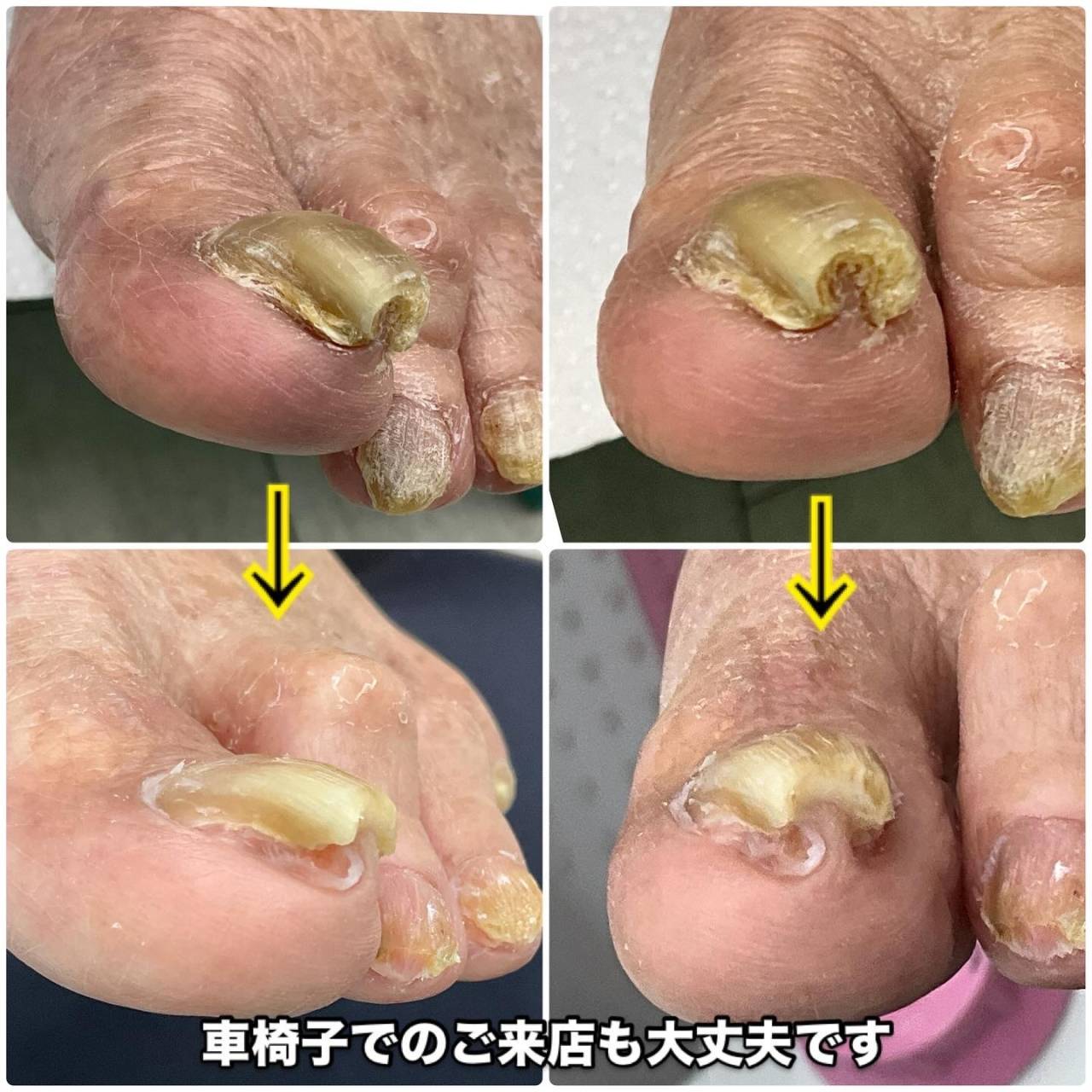 高齢者の分厚くなった爪のケア