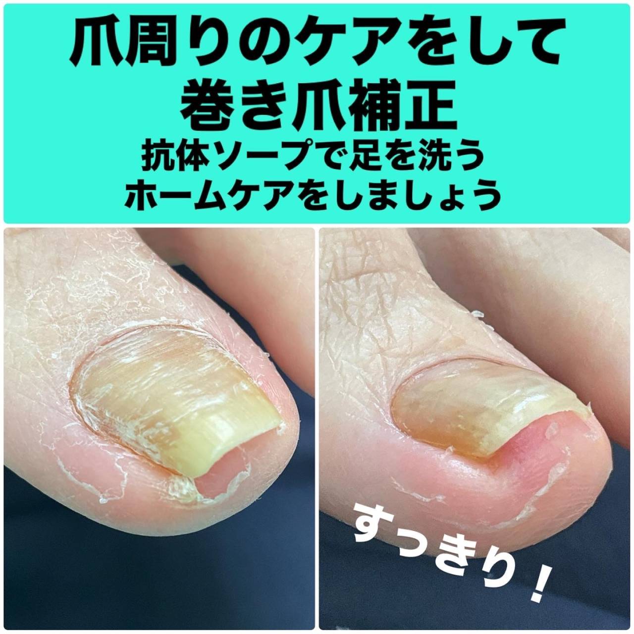 巻き爪のカット・補正、ホームケアで経過を見ます