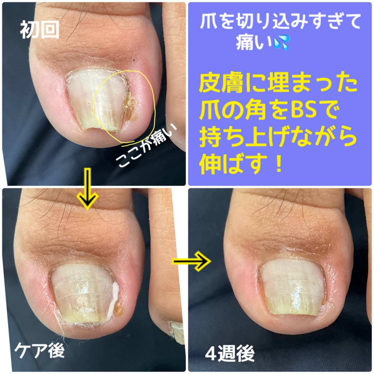 爪が食い込んで痛い「陥入爪」のケア