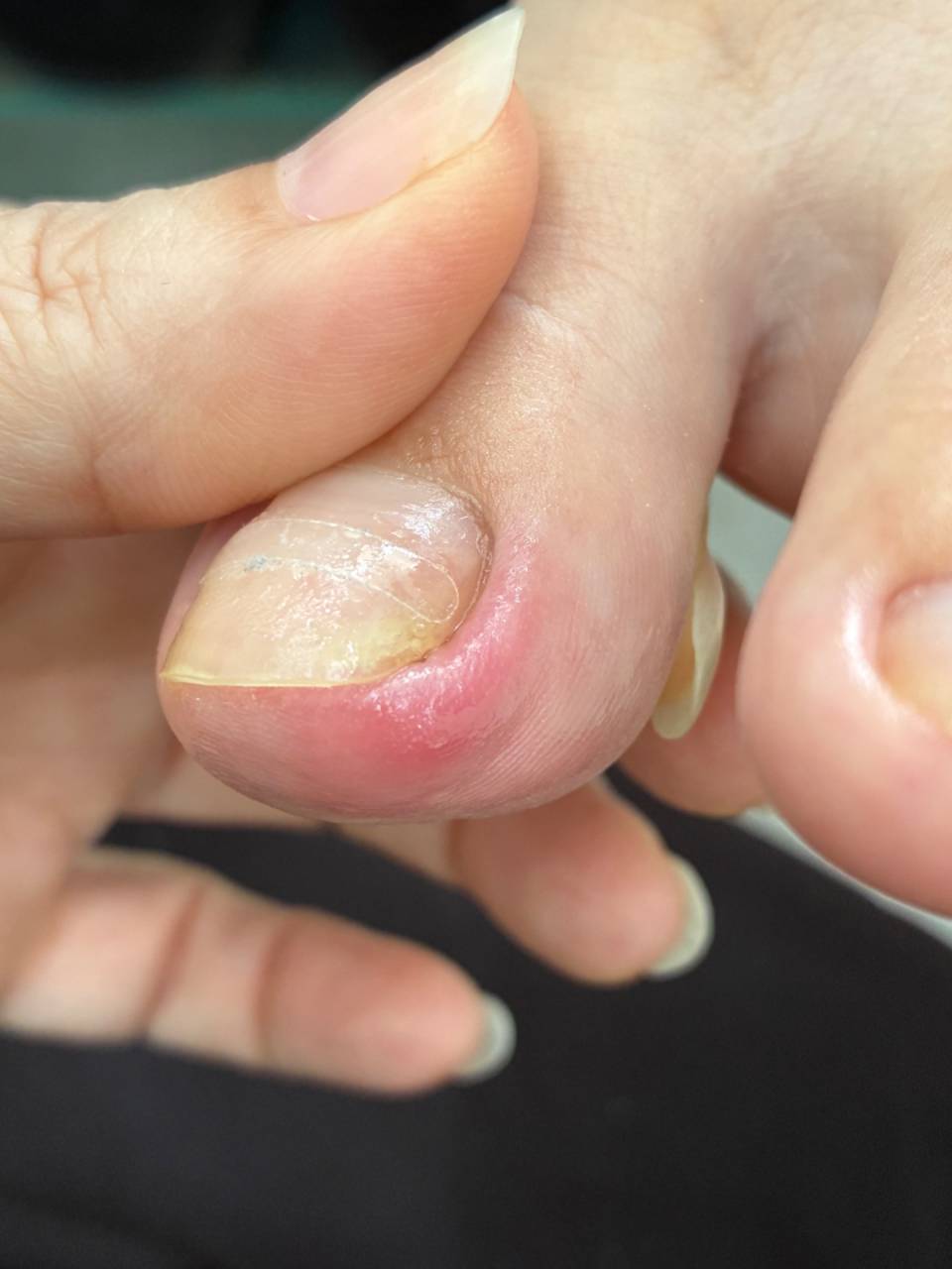 爪のトゲを丁寧にカットして、補正のプレートを付けて経過を見ます