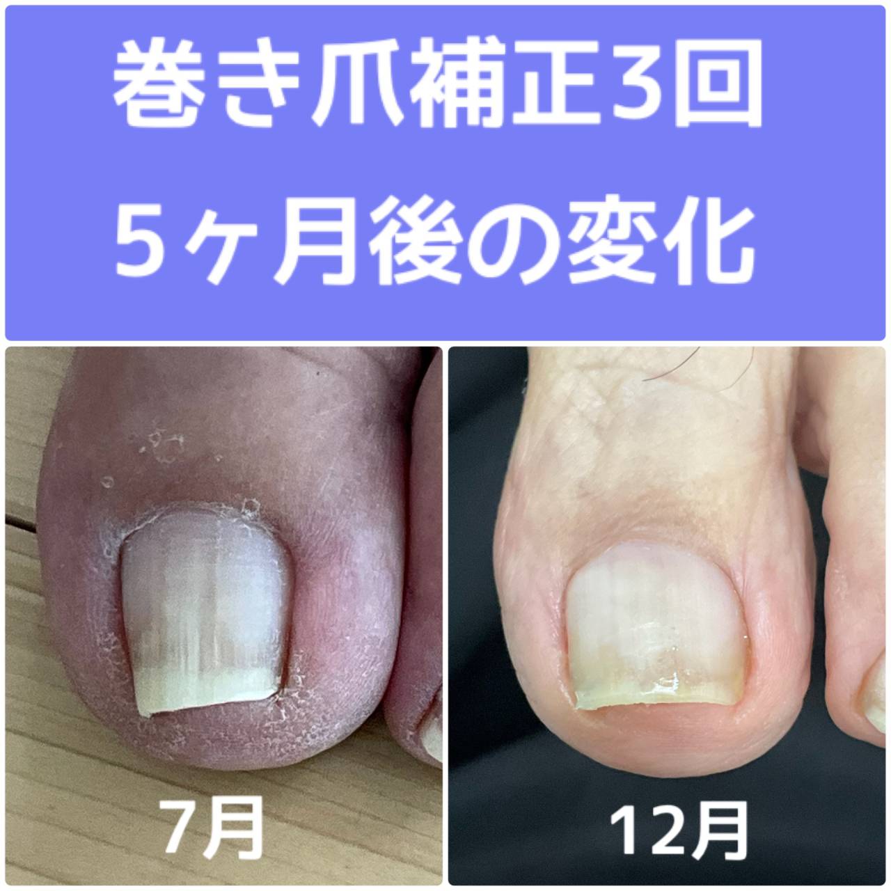 巻き爪補正の経過