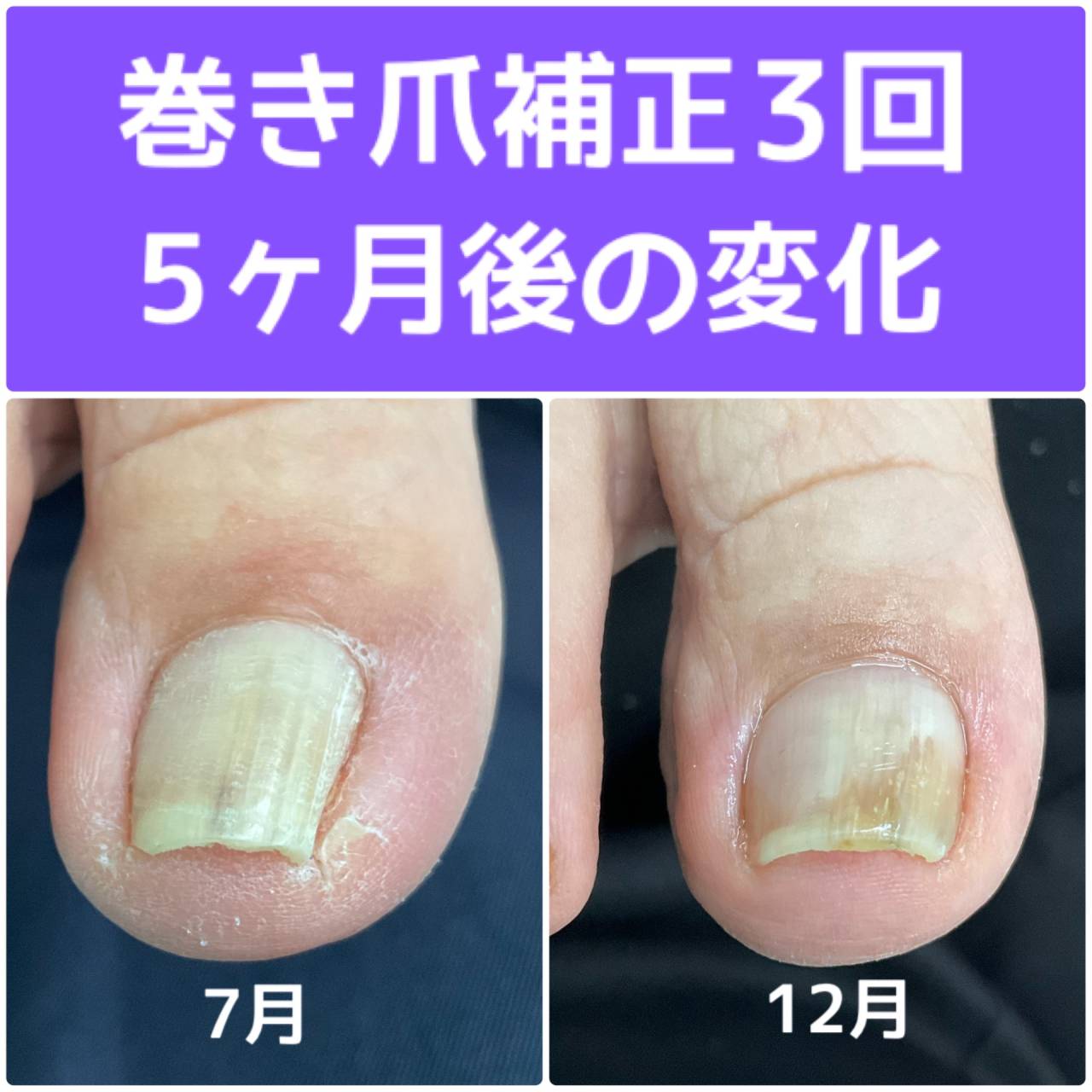 巻き爪補正の経過