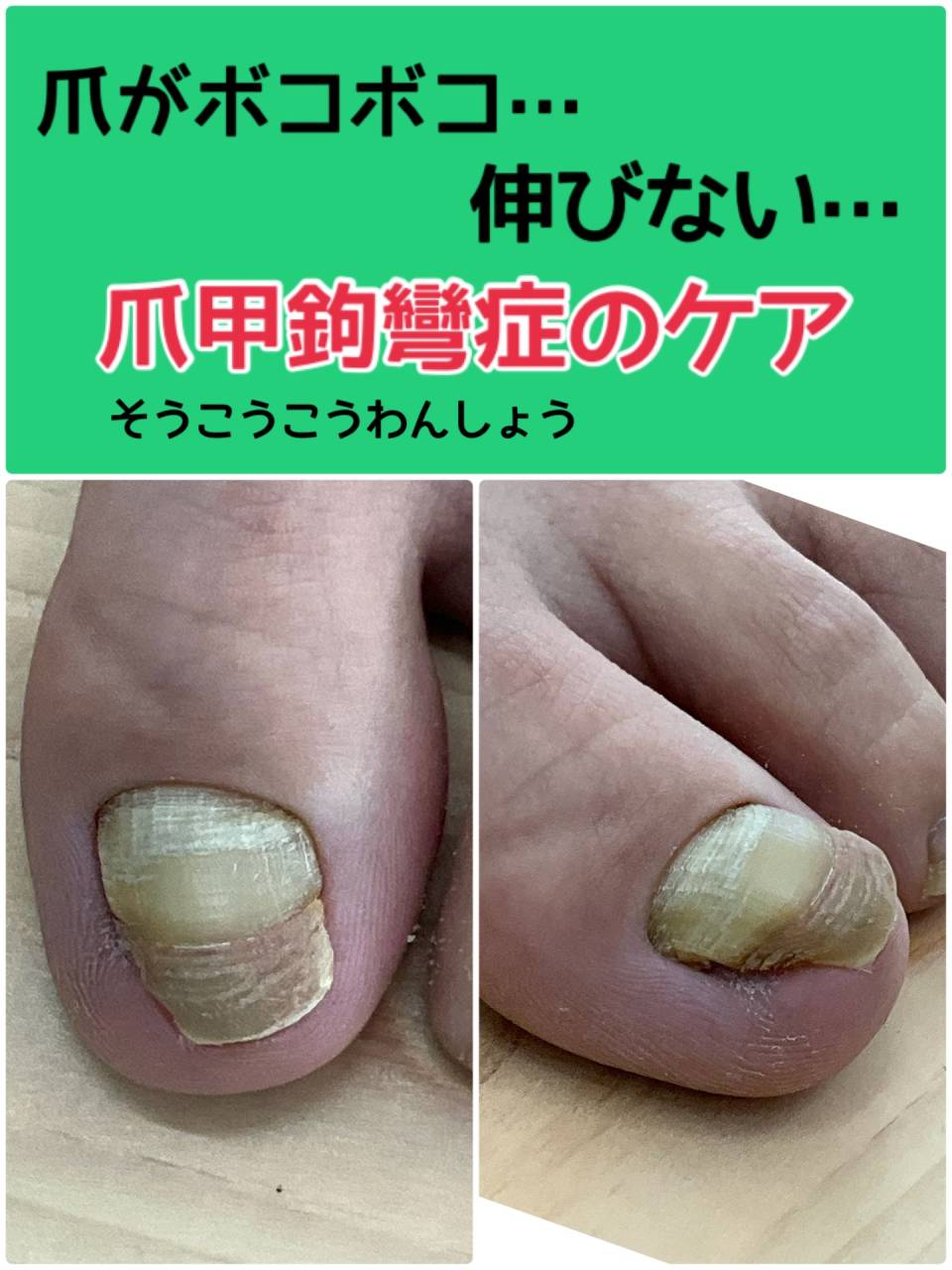 爪がぼこぼこ、爪の色が悪い、伸びない、「爪甲鉤彎症」」のケア