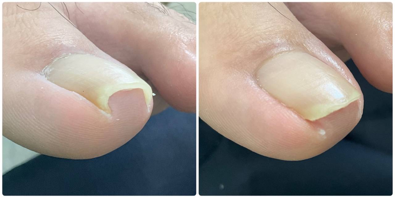 補正無し、巻き爪のカットだけでスッキリ！