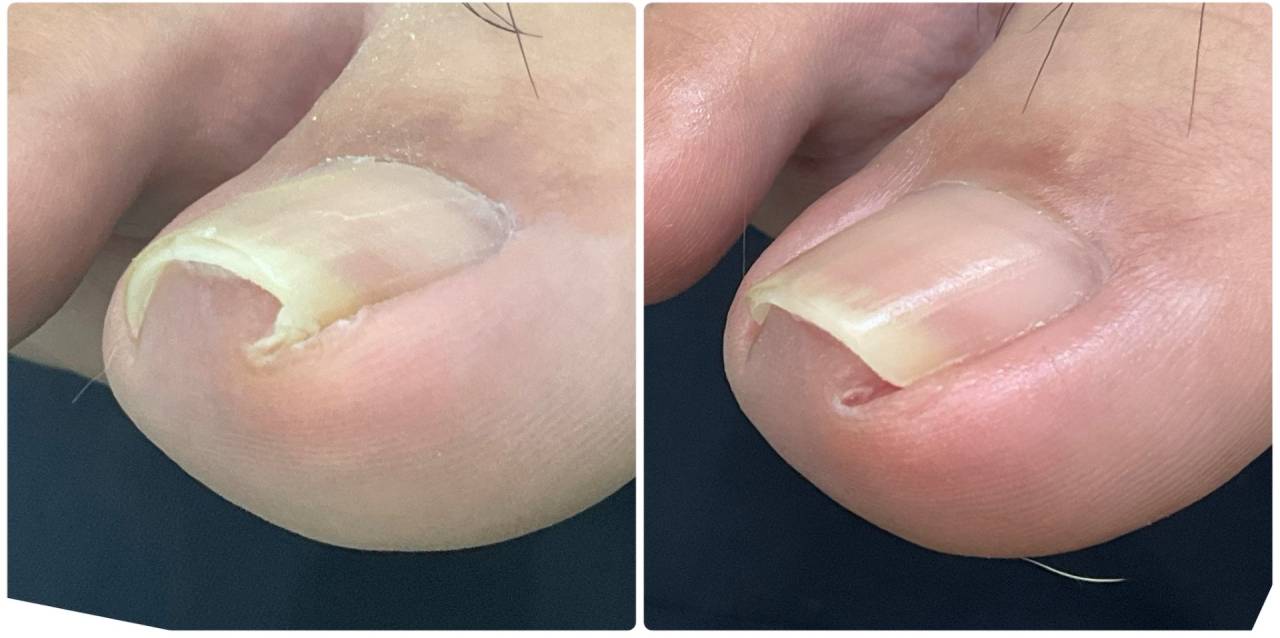 補正無し、巻き爪のカットだけでスッキリ!