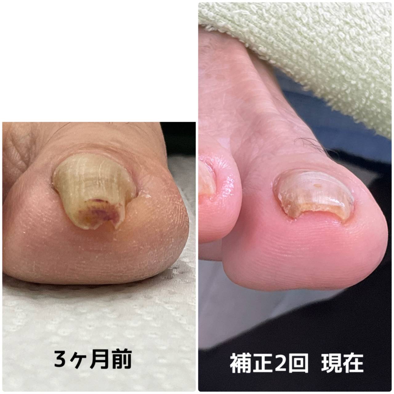 巻き爪は放っておいても改善しません。痛くなくても対策を！