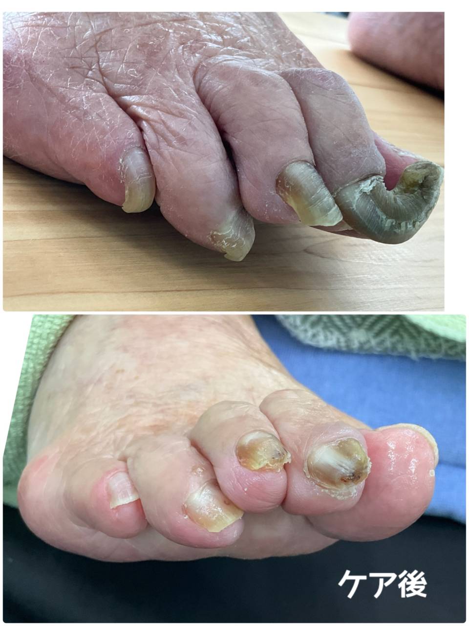 高齢者の肥厚、変形爪のケア