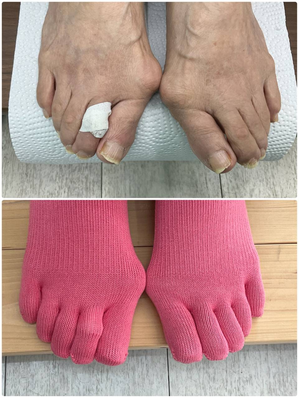 外反母趾は痛くなくても対策すべき！