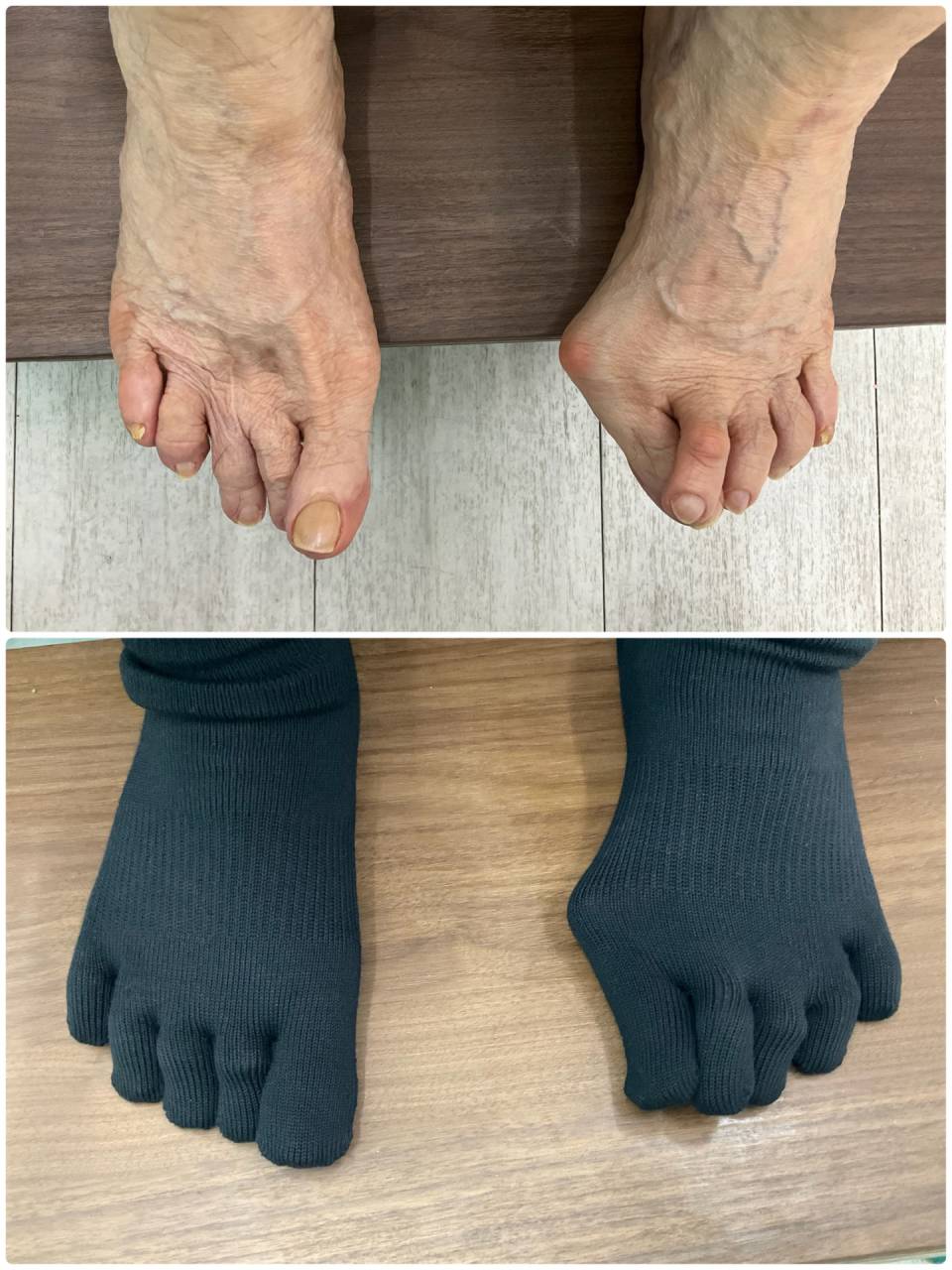 外反母趾矯正にCSソックス