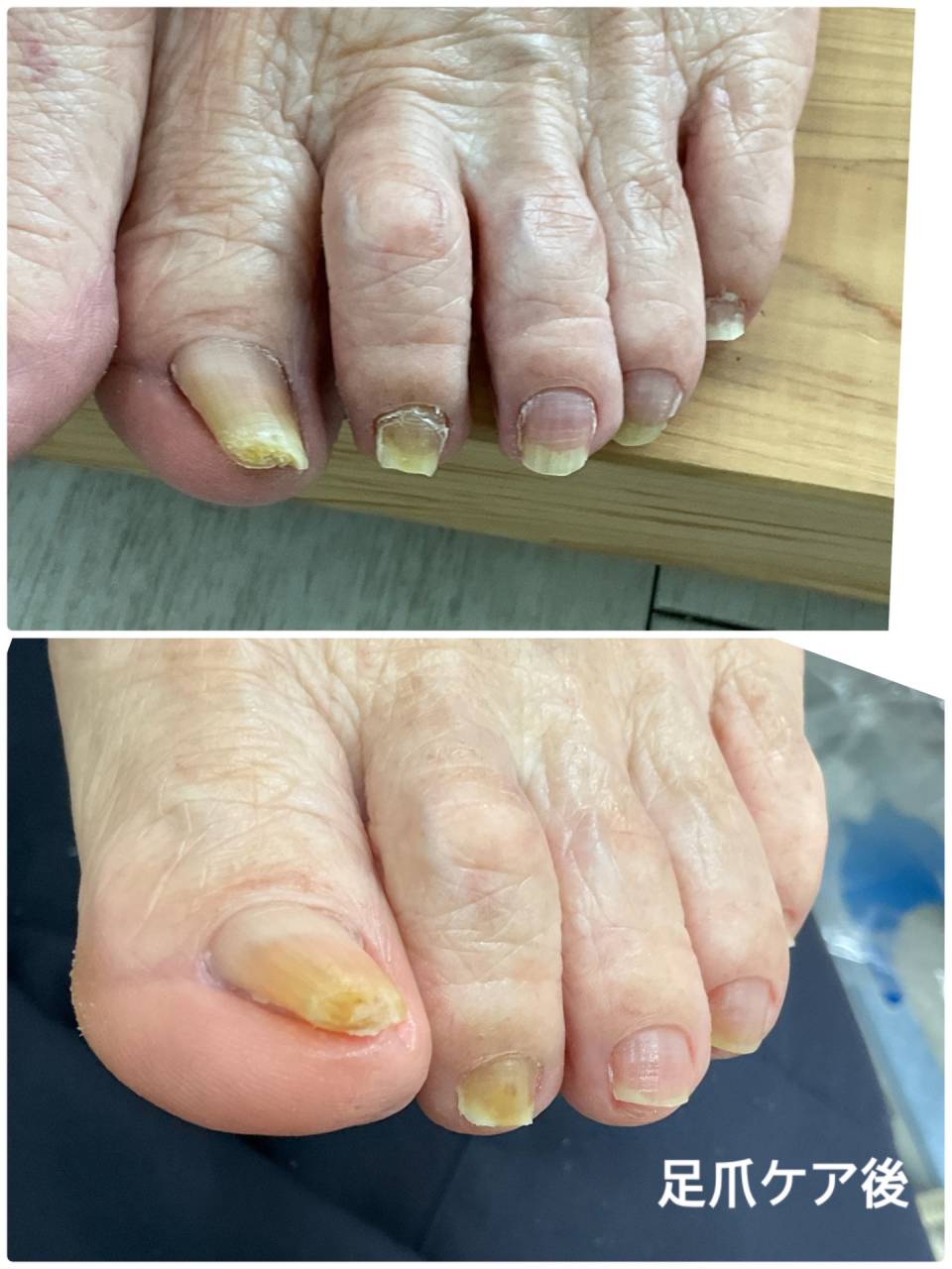 足の爪が巻いたり、爪が変形して、切るのが難しい