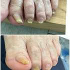 足の爪が巻いたり、爪が変形して、切るのが難しい