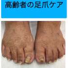 お年寄りの足の爪切り、フットケア、分厚い爪、お任せください